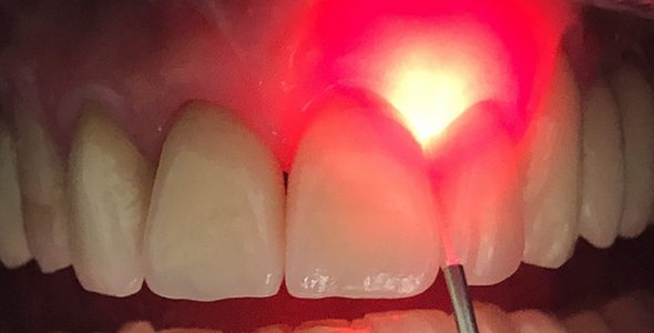 آشنایی با نحوه درمان با لیزر در دندانپزشکی